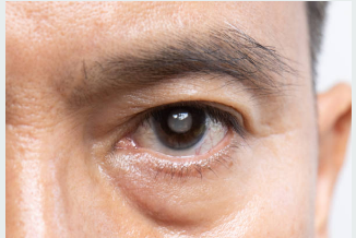 catarct 1